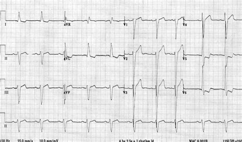 Left Ventricular Hypertrophy (LVH) • LITFL • ECG 